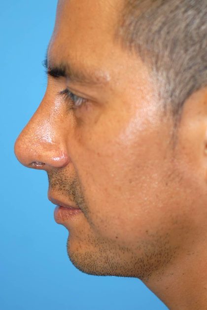 Rhinoplasty Before & After Patient #1580