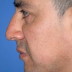 Rhinoplasty Before & After Patient #1580