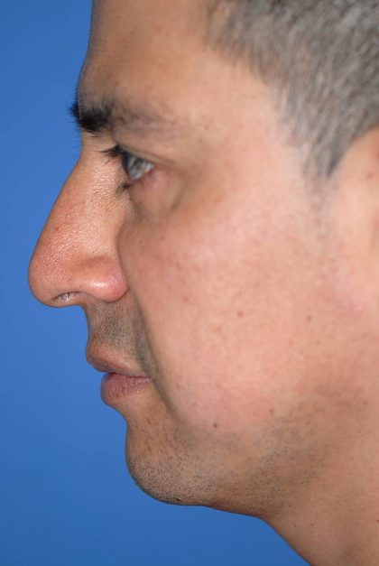 Rhinoplasty Before & After Patient #1580