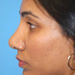 Rhinoplasty Before & After Patient #1579