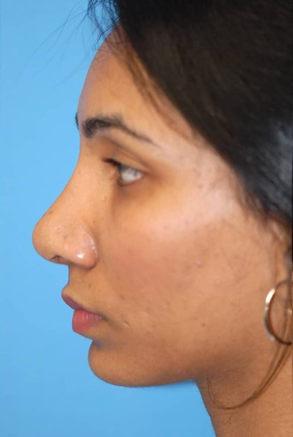 Rhinoplasty Before & After Patient #1579