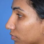 Rhinoplasty Before & After Patient #1579