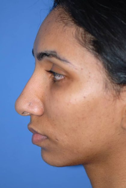 Rhinoplasty Before & After Patient #1579