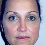 Rhinoplasty Before & After Patient #1578