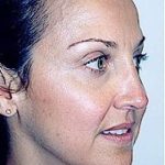 Rhinoplasty Before & After Patient #1578