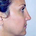 Rhinoplasty Before & After Patient #1578