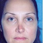 Rhinoplasty Before & After Patient #1578