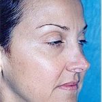 Rhinoplasty Before & After Patient #1578