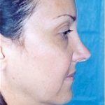 Rhinoplasty Before & After Patient #1578