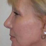 Rhinoplasty Before & After Patient #1577