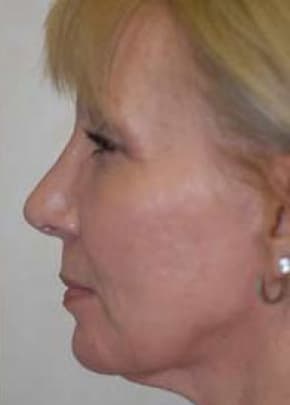 Rhinoplasty Before & After Patient #1577