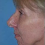Rhinoplasty Before & After Patient #1577