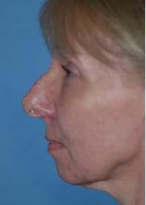 Rhinoplasty Before & After Patient #1577