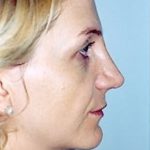 Rhinoplasty Before & After Patient #1576