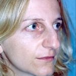 Rhinoplasty Before & After Patient #1576