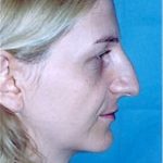 Rhinoplasty Before & After Patient #1576