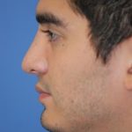 Rhinoplasty Before & After Patient #1575
