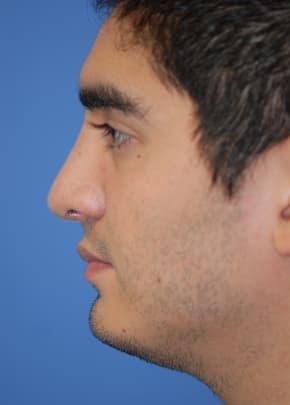 Rhinoplasty Before & After Patient #1575