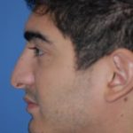 Rhinoplasty Before & After Patient #1575