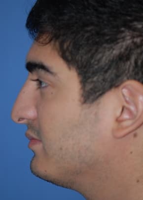 Rhinoplasty Before & After Patient #1575