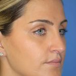 Rhinoplasty Before & After Patient #1574