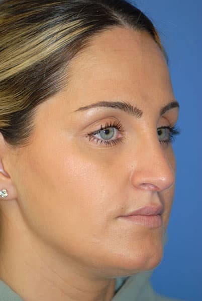 Rhinoplasty Before & After Patient #1574