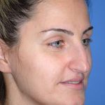 Rhinoplasty Before & After Patient #1574