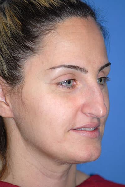 Rhinoplasty Before & After Patient #1574
