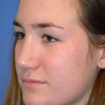 Rhinoplasty Before & After Patient #1573