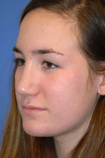 Rhinoplasty Before & After Patient #1573