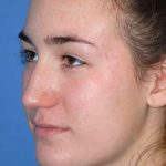 Rhinoplasty Before & After Patient #1573