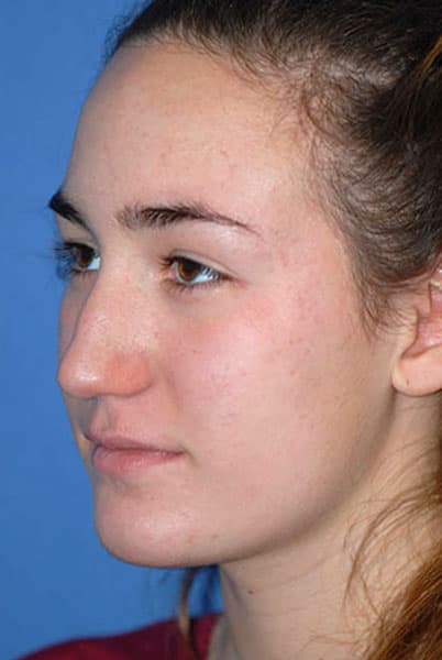 Rhinoplasty Before & After Patient #1573