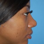 Rhinoplasty Before & After Patient #1572