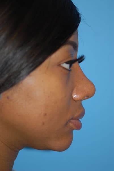 Rhinoplasty Before & After Patient #1572