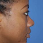 Rhinoplasty Before & After Patient #1572
