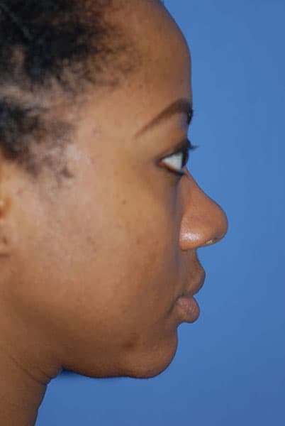 Rhinoplasty Before & After Patient #1572