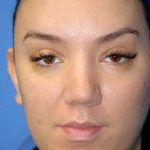 Rhinoplasty Before & After Patient #1571