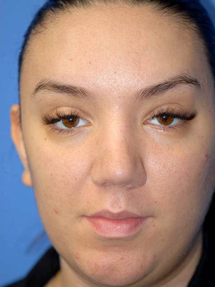 Rhinoplasty Before & After Patient #1571