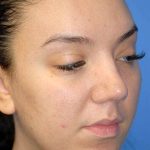 Rhinoplasty Before & After Patient #1571
