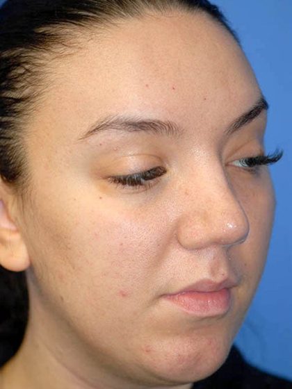 Rhinoplasty Before & After Patient #1571