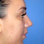 Rhinoplasty Before & After Patient #1571