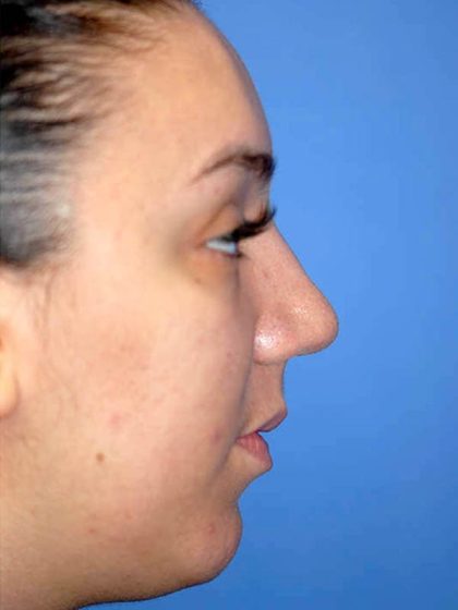Rhinoplasty Before & After Patient #1571