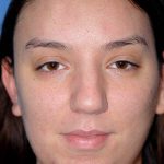 Rhinoplasty Before & After Patient #1571