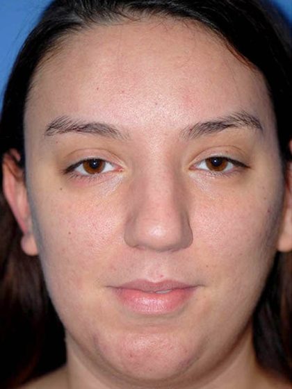 Rhinoplasty Before & After Patient #1571
