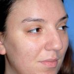 Rhinoplasty Before & After Patient #1571