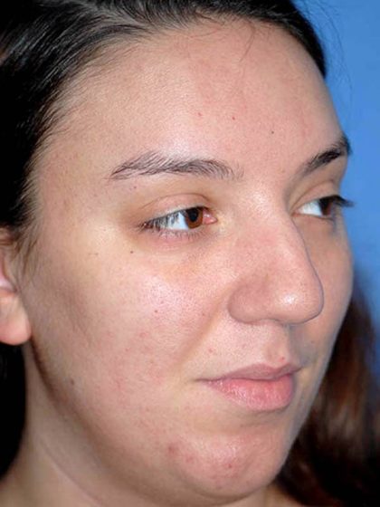 Rhinoplasty Before & After Patient #1571