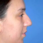 Rhinoplasty Before & After Patient #1571