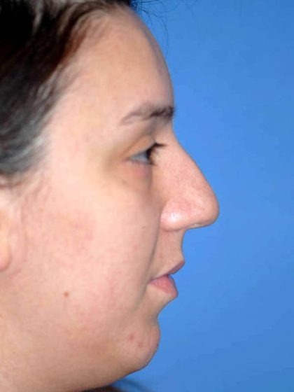 Rhinoplasty Before & After Patient #1571