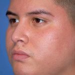 Rhinoplasty Before & After Patient #1570