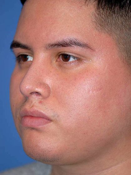 Rhinoplasty Before & After Patient #1570